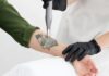 How to Manage Pain During Laser Tattoo Removal Laser Tattoo Removal