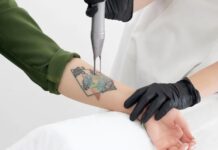 How to Manage Pain During Laser Tattoo Removal Laser Tattoo Removal
