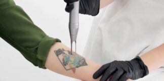 How to Manage Pain During Laser Tattoo Removal Laser Tattoo Removal