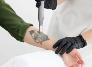 How to Manage Pain During Laser Tattoo Removal Laser Tattoo Removal