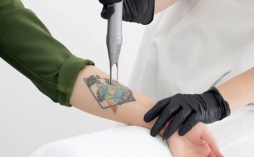 How to Manage Pain During Laser Tattoo Removal Laser Tattoo Removal