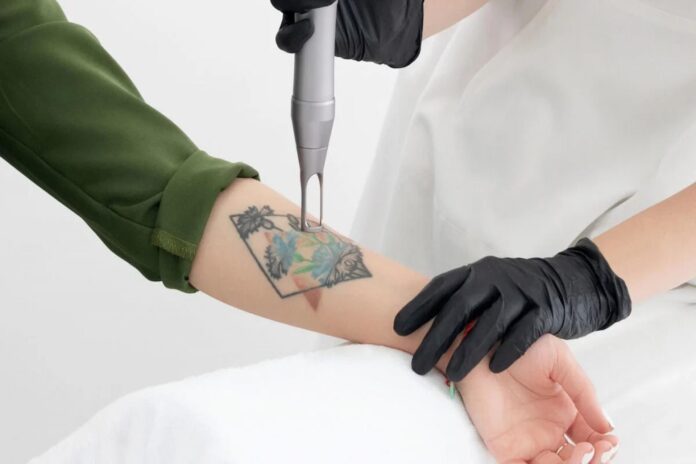 Laser Tattoo Removal
